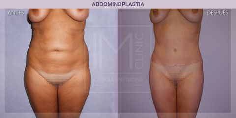 Abdominoplastia - IM CLINIC