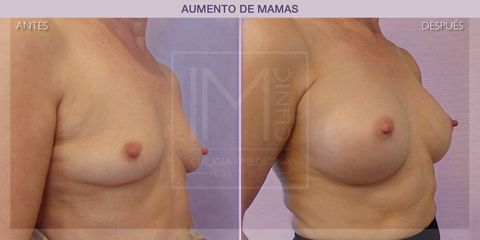 Aumento de pecho - IM CLINIC