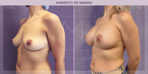 Aumento de pecho - IM CLINIC