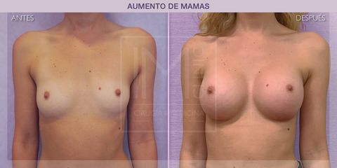Aumento de pecho - IM CLINIC