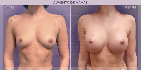 Aumento de pecho - IM CLINIC