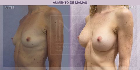 Aumento de pecho - IM CLINIC