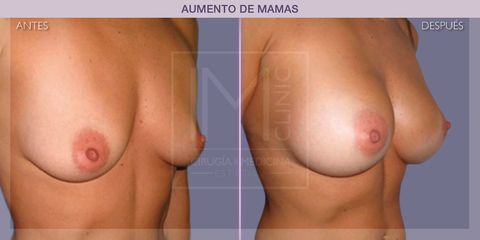 Aumento de pecho - IM CLINIC