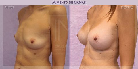 Aumento de pecho - IM CLINIC