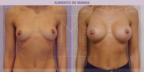 Aumento de pecho - IM CLINIC