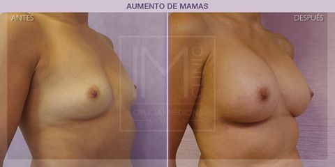 Aumento de pecho - IM CLINIC