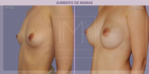 Aumento de pecho - IM CLINIC
