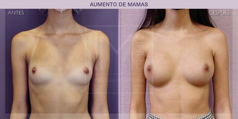 Aumento de pecho - IM CLINIC