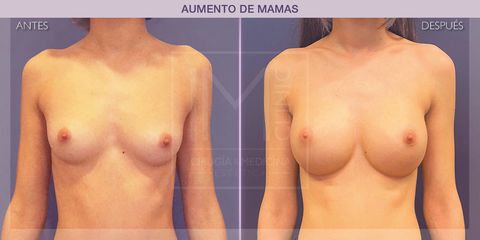 Aumento de pecho - IM CLINIC