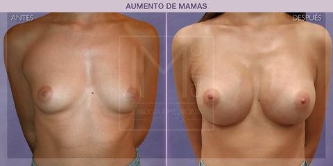 Aumento de pecho - IM CLINIC