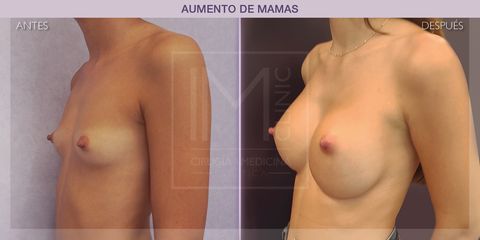 Aumento de pecho - IM CLINIC