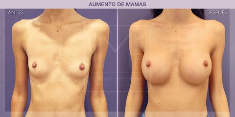 Aumento de pecho - IM CLINIC