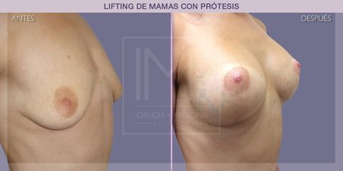 Lifting mamas - IM CLINIC