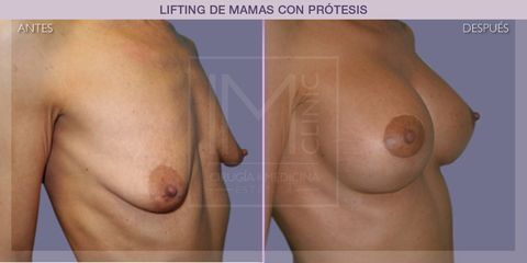 Lifting mamas - IM CLINIC
