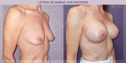 Lifting mamas - IM CLINIC
