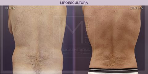 Lipoescultura - IM CLINIC