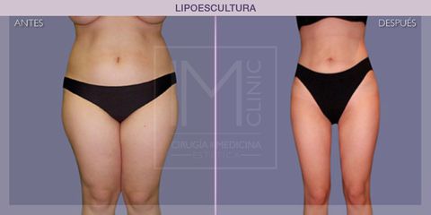 Lipoescultura - IM CLINIC