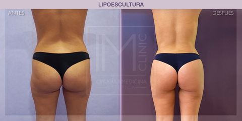 Lipoescultura - IM CLINIC