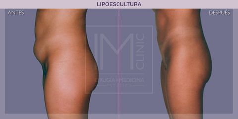 Lipoescultura - IM CLINIC