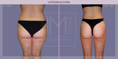 Lipoescultura - IM CLINIC
