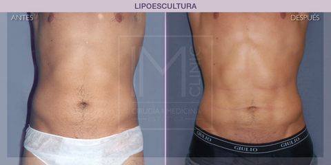 Lipoescultura - IM CLINIC