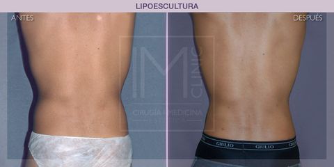 Lipoescultura - IM CLINIC