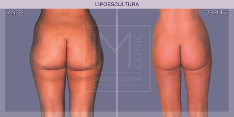Lipoescultura - IM CLINIC