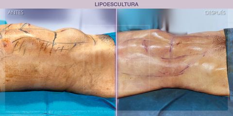 Lipoescultura - IM CLINIC