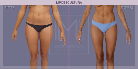 Lipoescultura - IM CLINIC