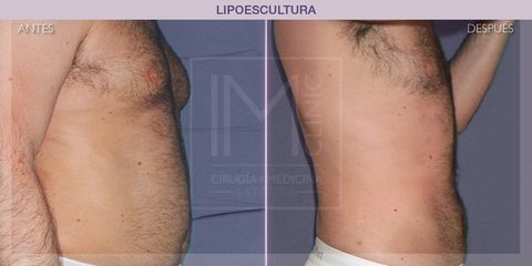 Lipoescultura - IM CLINIC