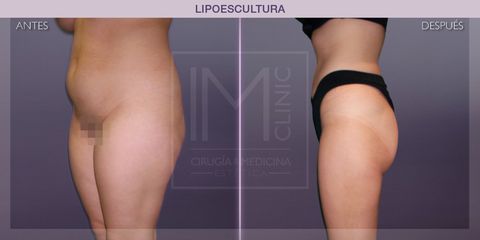 Lipoescultura - IM CLINIC