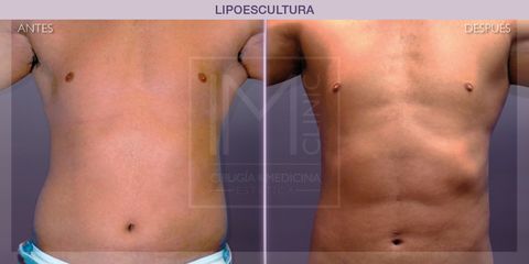 Lipoescultura - IM CLINIC