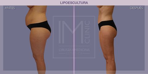 Lipoescultura - IM CLINIC