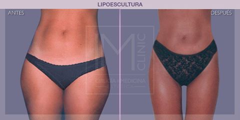 Lipoescultura - IM CLINIC