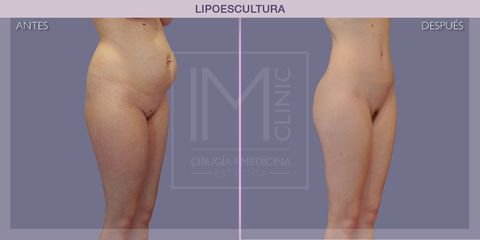 Lipoescultura - IM CLINIC
