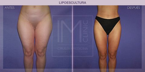 Lipoescultura - IM CLINIC
