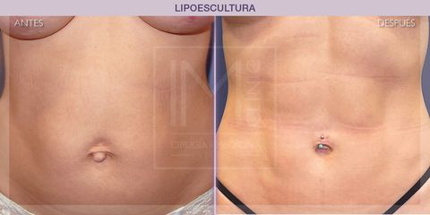 Lipoescultura - IM CLINIC