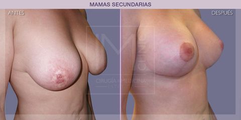 Mastopexia - IM CLINIC
