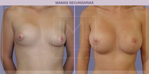 Mastopexia - IM CLINIC