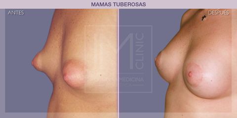 Mamas tuberosas - IM CLINIC