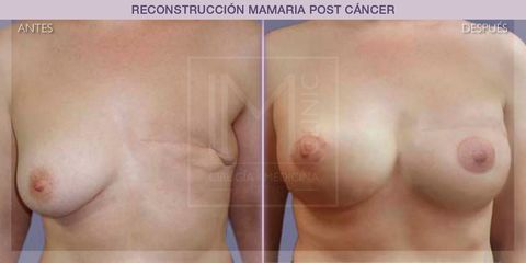 Reconstrucción mamaria - IM CLINIC