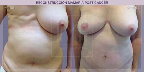Reconstrucción mamaria - IM CLINIC