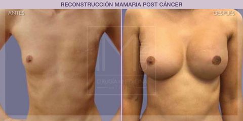 Reconstrucción mamaria - IM CLINIC