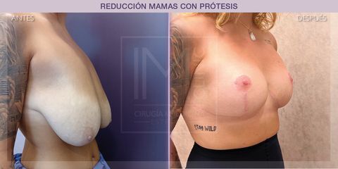 Reducción mamas - IM CLINIC
