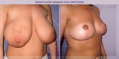 Reducción mamas - IM CLINIC