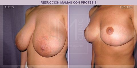 Reducción mamas - IM CLINIC