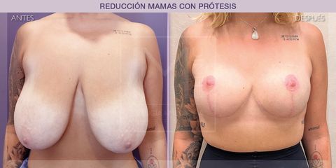 Reducción mamas - IM CLINIC