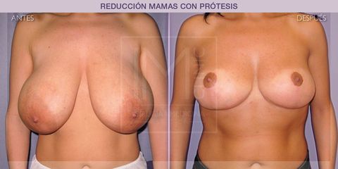 Reducción mamas - IM CLINIC