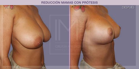 Reducción mamas - IM CLINIC