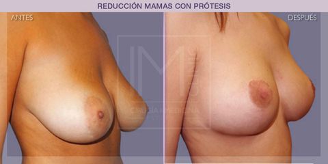 Reducción mamas - IM CLINIC